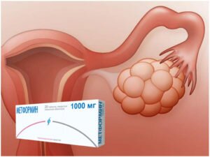 Метформин – инструкция по применению при поликистозе яичников